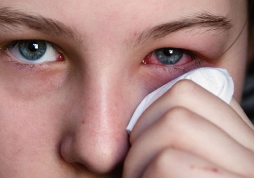 Allergie
