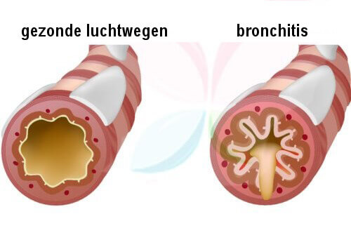 Gezonde luchtwegen en bronchitis