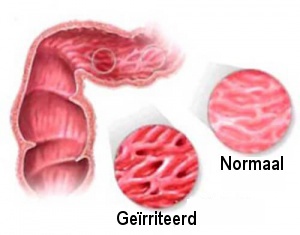 Aandacht! Verboden voedsel bij prikkelbare darmen