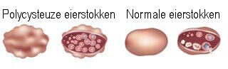Eierstokken_2