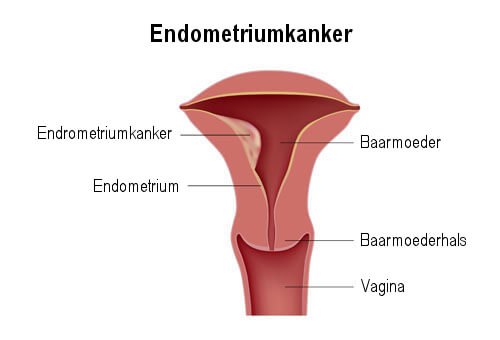 Baarmoederkanker ofwel endometriumcarcinoom