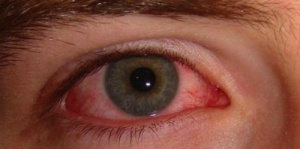 Hoe voorkom je rode ogen? Oorzaken en remedies