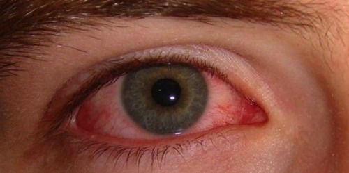 Hoe voorkom je rode ogen? Oorzaken en remedies