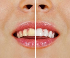 Tips natuurlijk witte tanden - Gezonder Leven