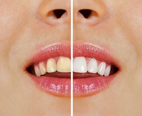 Tips voor natuurlijk witte tanden