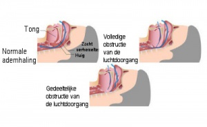 Natuurlijke middeltjes tegen snurken