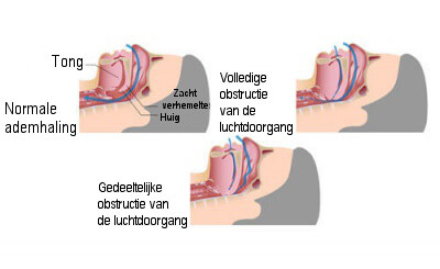 Remedies tegen snurken Remedies tegen snurken