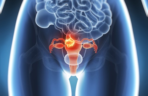 60 procent van baarmoederkanker kan worden voorkomen