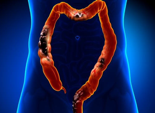 Te mijden voedsel als je aan diverticulose lijdt Te mijden voedsel als je aan diverticulose lijdt