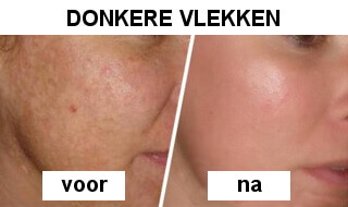 Appelazijn tegen vlekken in het gezicht