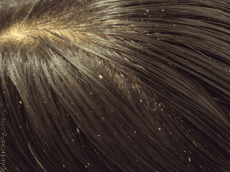 Natuurlijke middelen tegen roos