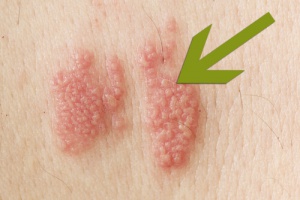 Gordelroos: wat is het en hoe ziet het eruit?