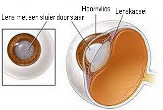 Grijze staar geïllustreerd