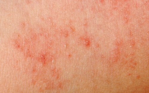 huid-allergie