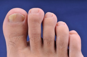 Huisremedies tegen schimmelnagels