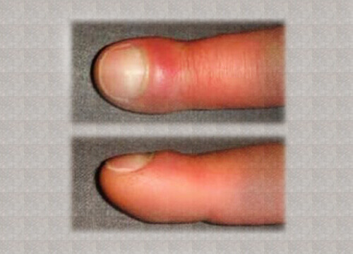 Wat veroorzaakt opgezette vingers?