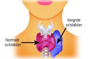 Hyperthyreoïdie bij vrouwen: symptomen en voeding