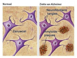 Voedsel dat beschermt tegen Alzheimer