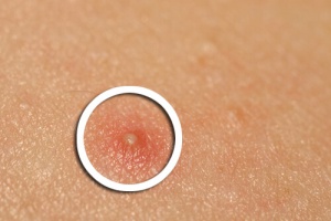 Middel van groene thee tegen acne