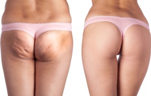 De beste natuurlijke behandelingen tegen cellulite