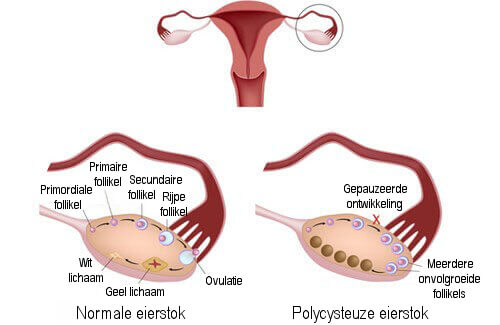 Wat is Polycysteus Ovarium Syndroom en hoe wordt het behandeld?