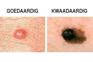 Waar moet je op letten bij moedervlekken?