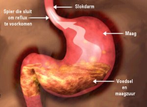 Het goede dieet voor mensen met reflux