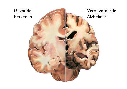 Alzheimer: tijdig de eerste symptomen detecteren
