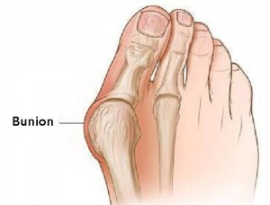 Waarom bunions ontstaan