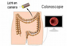 colonoscopie