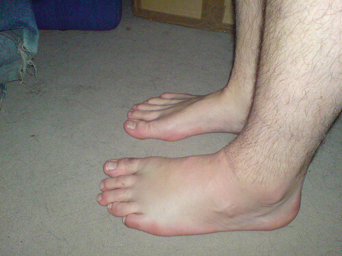 Natuurlijke diuretica tegen opgezwollen voeten