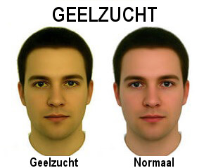 Het verschillen tussen een normale huid en geelzucht