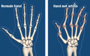 Artritis: 6 stappen om de impact te verlichten
