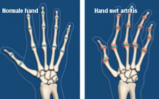 Hand met artritis
