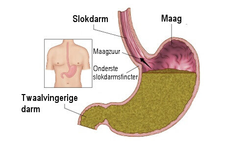 Overzicht van maagreflux