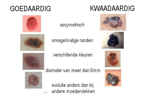 schema met moedervlekken