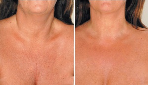 Remedies om nekrimpels te verminderen