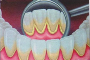 Natuurlijke remedies om tandplak te verwijderen