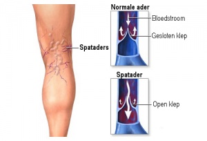 10 kruidenremedies tegen spataders