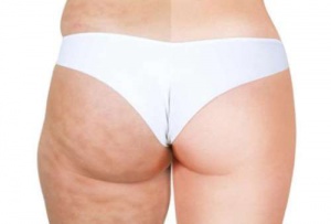 Massage om cellulite te elimineren