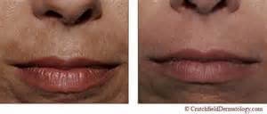 Een van de toepassingen van zuurstofwater is het gebruik bij huidverkleuring