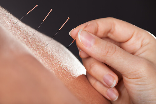 acupunctuur