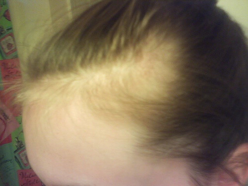 Vrouw met dunner wordend haar