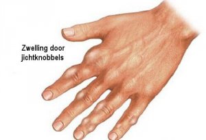 Urinezuur natuurlijk verminderen