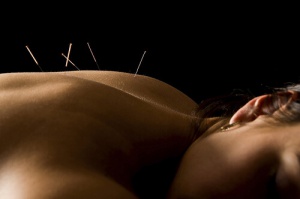 acupunctuur