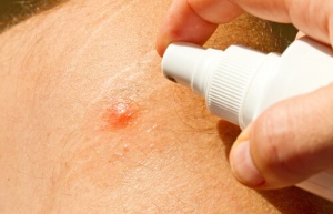 De beste zelfgemaakte middelen tegen muggen