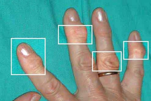 Natuurlijke remedies tegen artritis Natuurlijke remedies tegen artritis