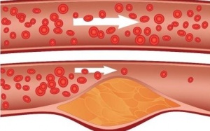 Cholesterol