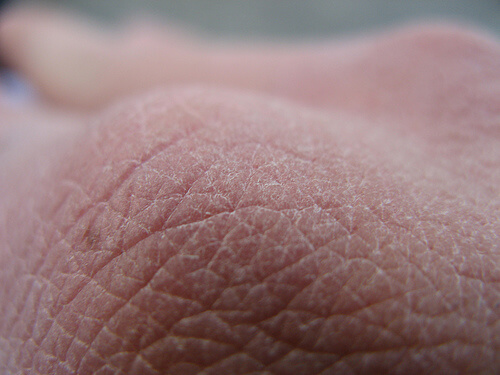 Ontcijfer de berichten van je huid door te letten op hele droge huid bijvoorbeeld