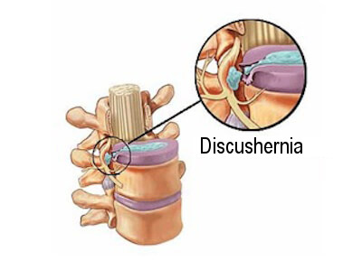 Symptomen van een gehernieerde discus